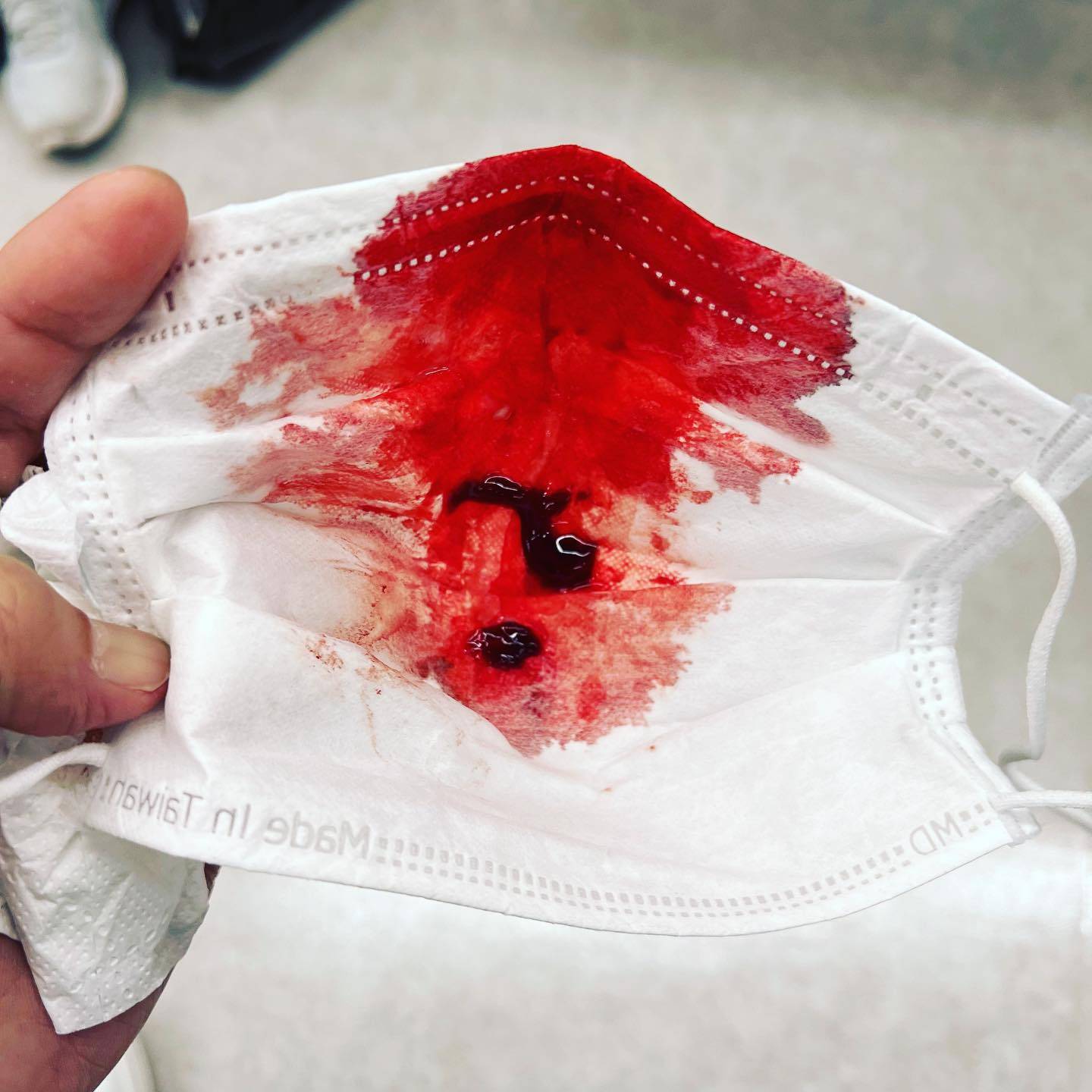 That's one bloody nose