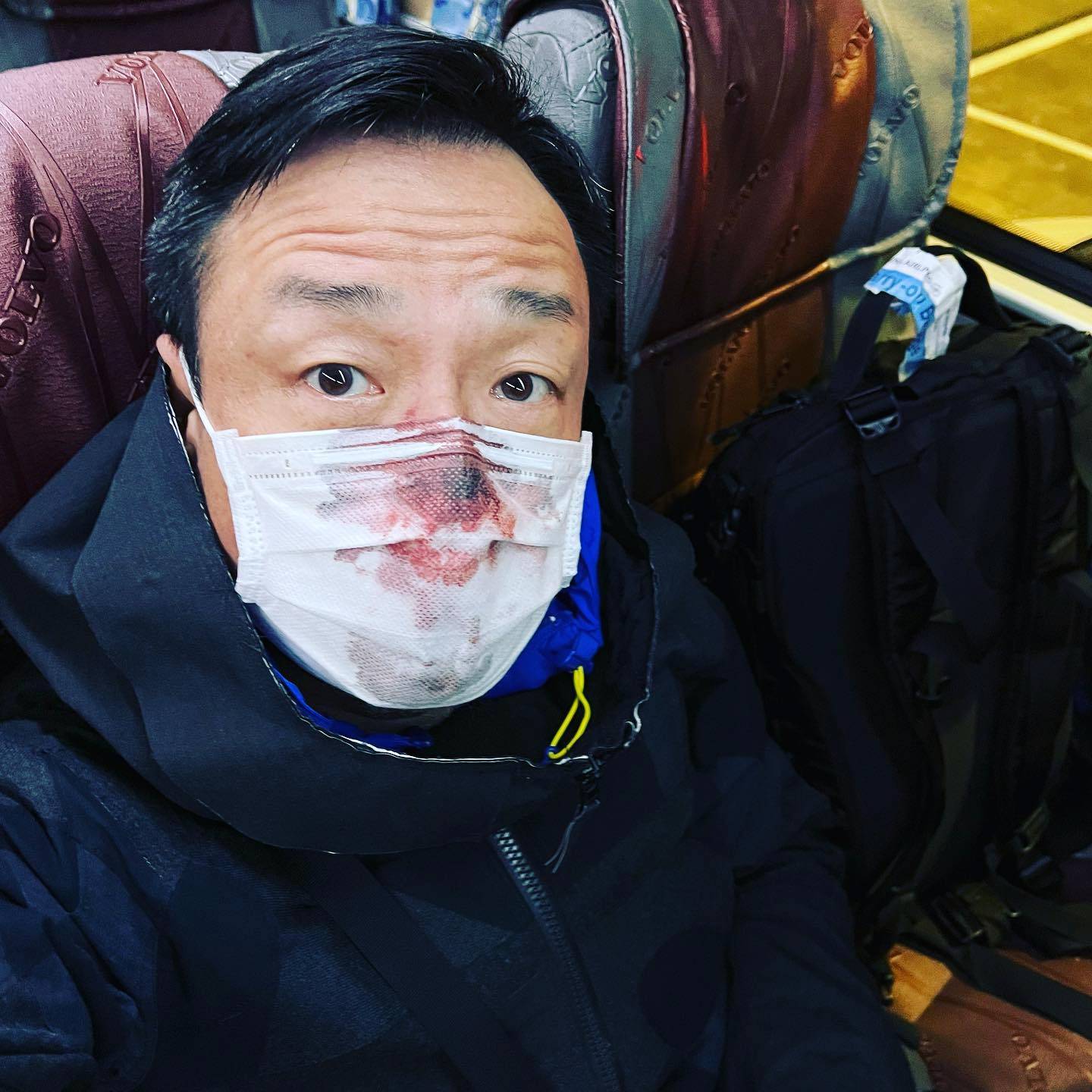 Wong Hei and his bloody nose on the way to the quarantine site