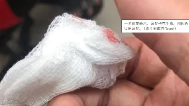 头发扎进手指别当小事！台湾男生四天后化脓最严重恐截肢