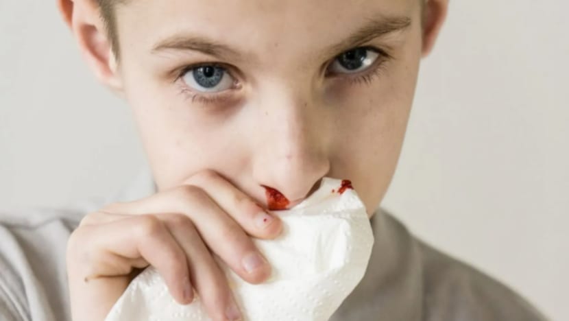 Cara atasi masalah hidung anak kerap berdarah
