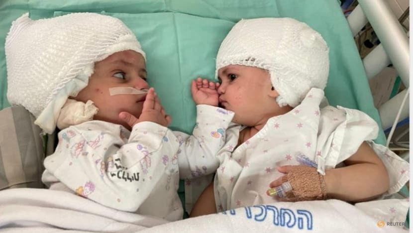Born conjoined back-to-back, Israeli twins finally see each other after surgery Born conjoined back-to-back, Israeli twins finally see each other after surgery