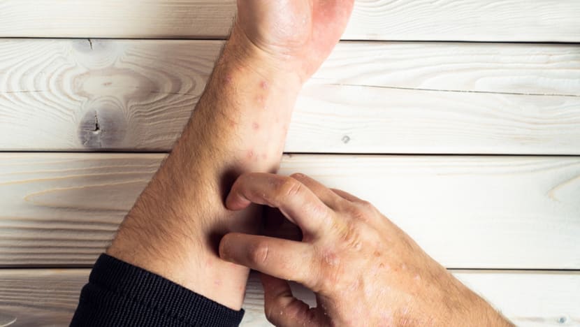 Alleviating the pain of psoriasis and psoriatic arthritis Alleviating the pain of psoriasis and psoriatic arthritis