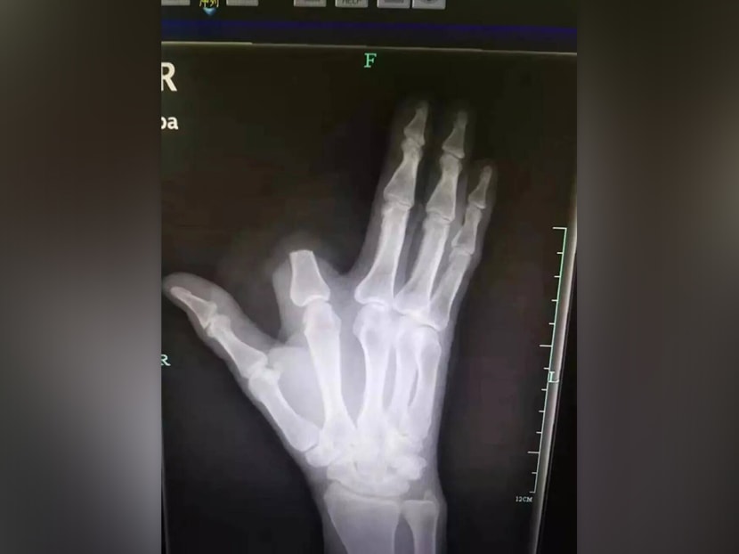 Doctors were unable to reattach the amputated finger.