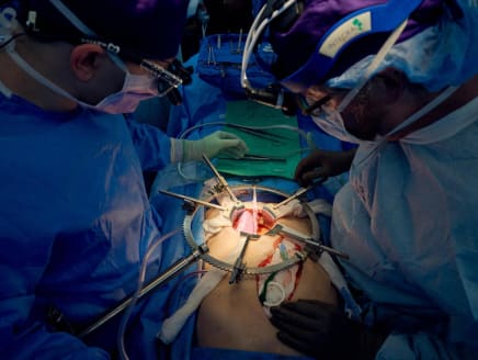 This July 14, 2023, image released by NYU Langone Health in New York, shows a team of surgeons transplanting a pig kidney.