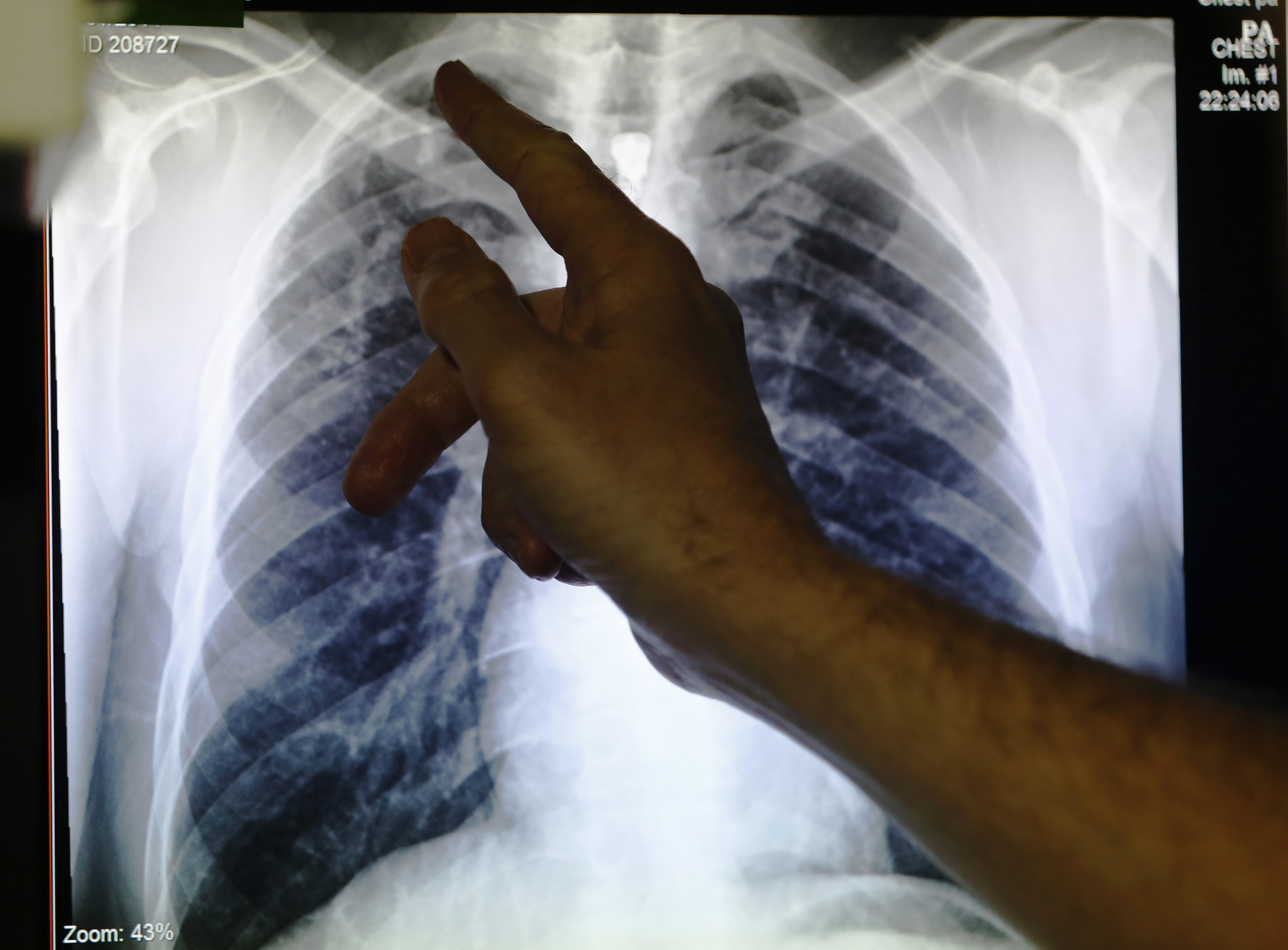 Tuberculosis is a curable airborne disease, with treatment rapidly reducing transmission. Tuberculosis is a curable airborne disease, with treatment rapidly reducing transmission.