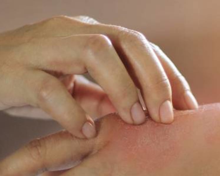 How to deal with eczema: Does skipping seafood help? Are essential oils effective?