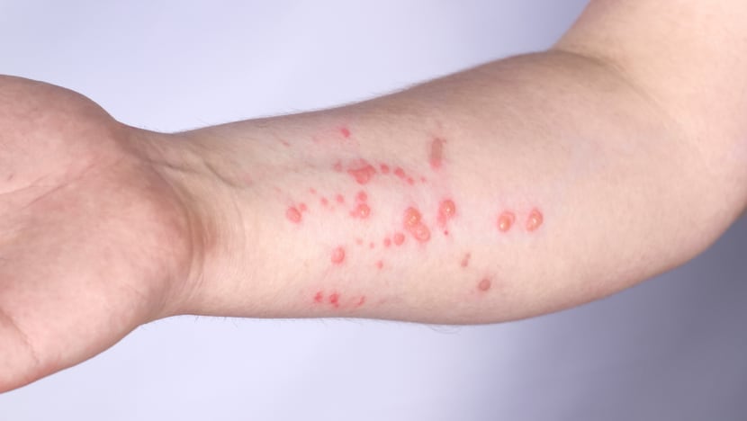 What's monkeypox?' Woman with 'insane rash' turned away for testing