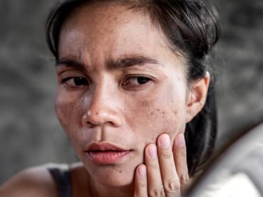 Melasma isn’t just a pregnancy thing, it can happen to any woman. And it’s all because of our hormones 