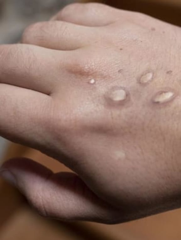 Singapore confirms imported case of monkeypox after flight attendant develops fever and rashes Singapore confirms imported case of monkeypox after flight attendant develops fever and rashes