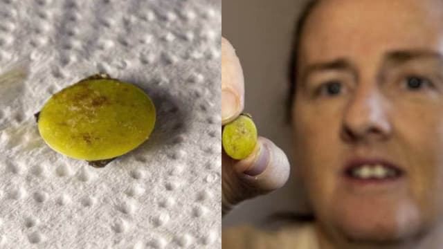 新西兰女子因冠病检测意外发现 玩具卡在鼻孔内37年