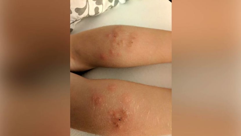 Bed bugs on planes: How to spot the signs and why they are 'almost impossible' to prevent Bed bugs on planes: How to spot the signs and why they are 'almost impossible' to prevent