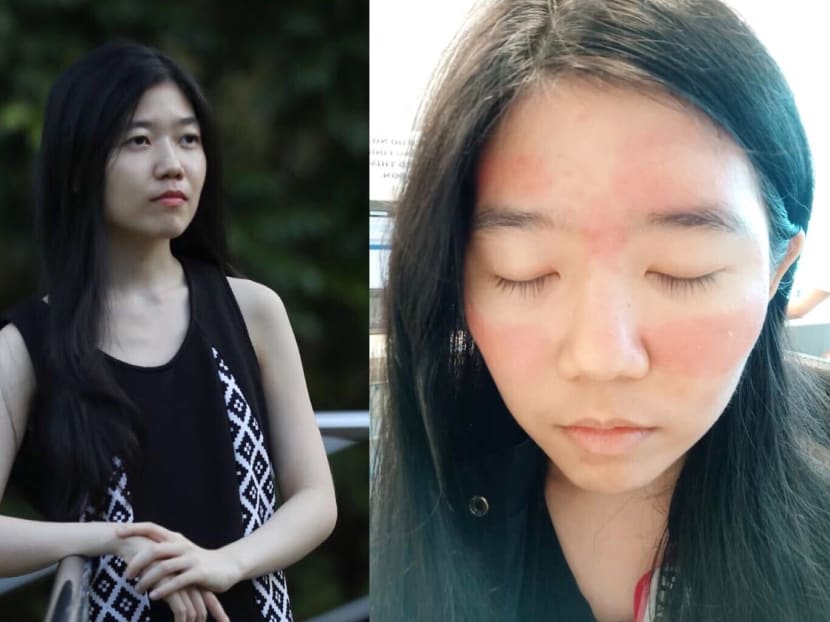 The author suffered her worst outbreak two years ago (right photo) when she had contact dermatitis, impetigo and acne in the area around her eyes.