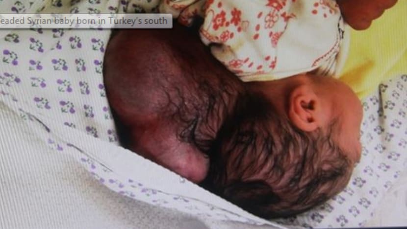 Bayi Syria ini dilahirkan dengan dua kepala