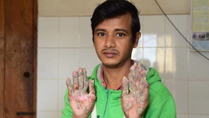 Bangladesh 'Tree Man' wants hands amputated to relieve pain Bangladesh 'Tree Man' wants hands amputated to relieve pain