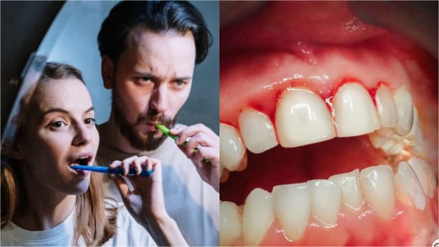 刷牙出血不寻常　牙周病可引发严重疾病