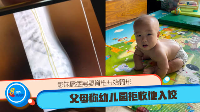 患侏儒症男婴脊椎开始畸形 父母称幼儿园拒收他入校