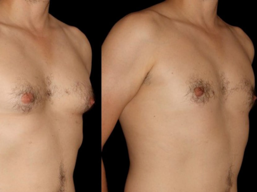 Before (left) and after liposuction (right), in which the patient had excess fat and breast tissue removed. Enlarged breasts in men, known as gynecomastia, affects about a third of all men over their lifetime. Photo: The Sloane Clinic Plastic Surgery Centre