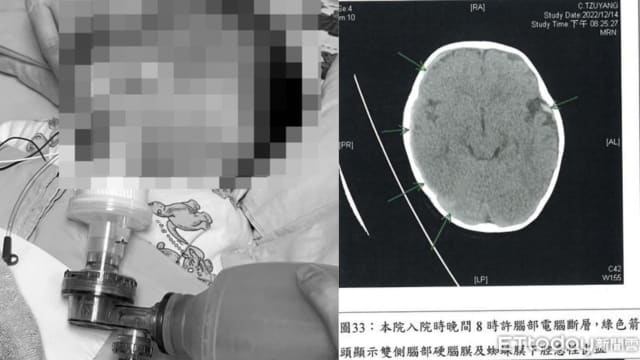台湾保姆不满八月大男婴哭闹 三天重摔14次致永久脑损