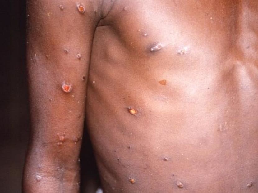 The Ministry of Health said that the Nigerian man who tested positive for monkeypox on May 8, 2019 has recovered and has been assessed to be non-infectious.