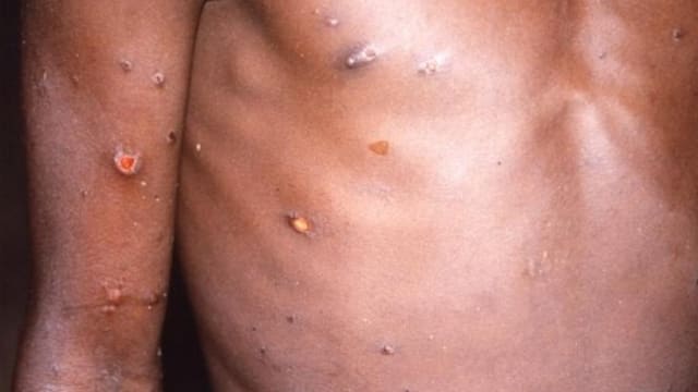 泰国首起猴痘确诊病例 潜逃柬埔寨后被捕送院治疗