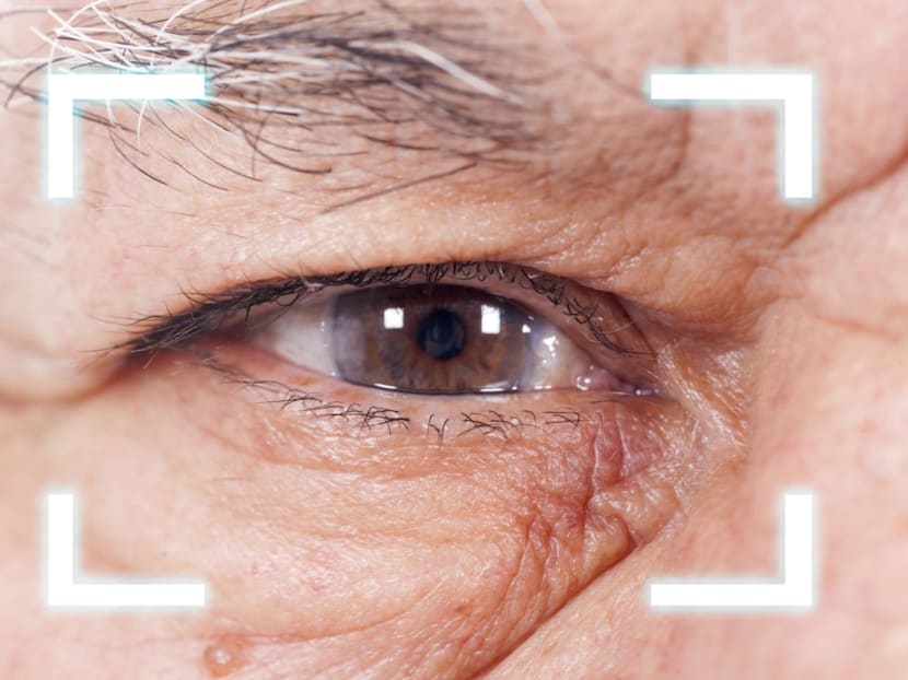 New study reveals cataract surgery may reduce dementia risk in older patients