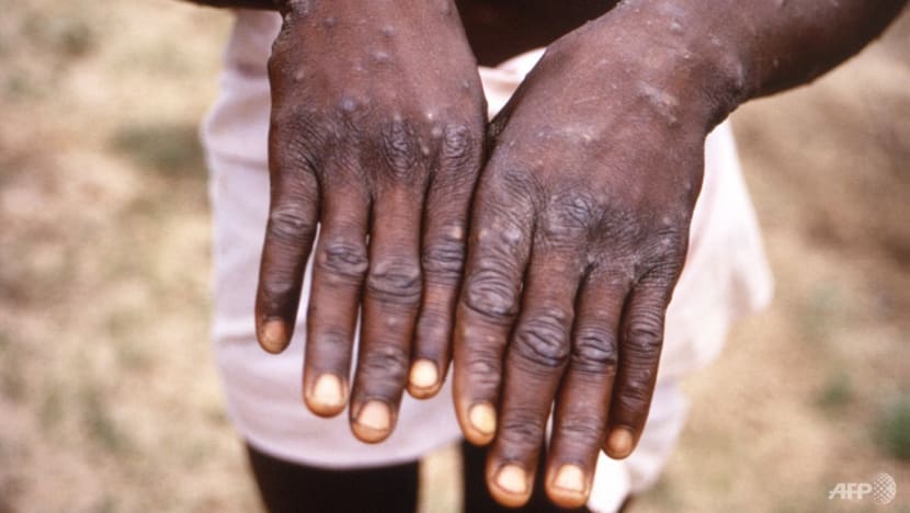 Commentary: Four ways the monkeypox outbreak can play out