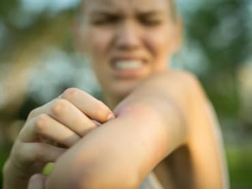 Fire ants, hornets, bed bugs: What to do if you get bitten or stung, and when to see a doctor