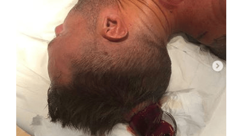 Calum Best loses 'cupcake of blood' during cupping therapy