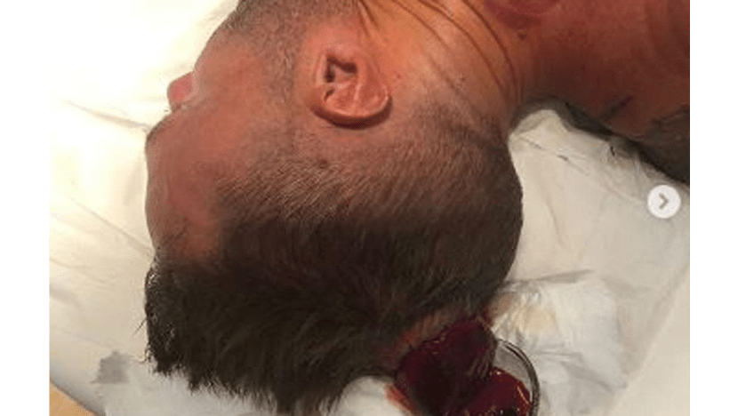 Calum Best loses 'cupcake of blood' during cupping therapy Calum Best loses 'cupcake of blood' during cupping therapy