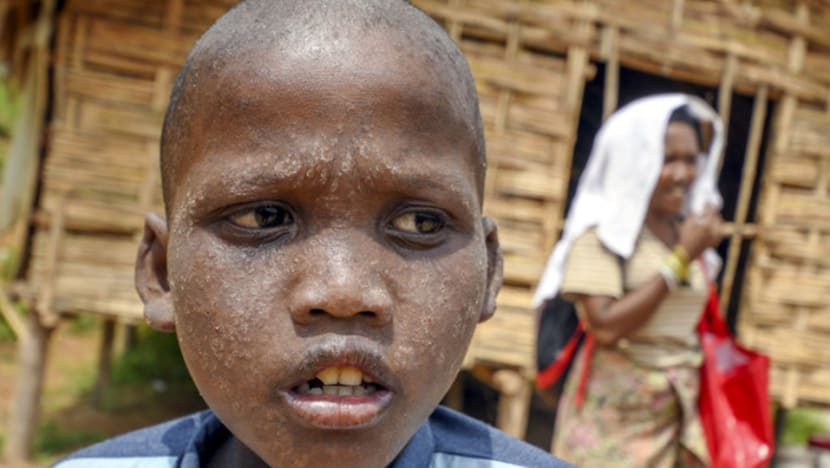 Kelantan settlement cordoned off after Orang Asli deaths, cause of illness yet to be identified Kelantan settlement cordoned off after Orang Asli deaths, cause of illness yet to be identified