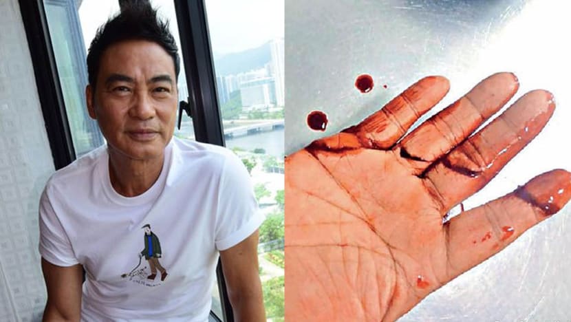 Simon Yam still has to visit the hospital daily despite being discharged a week ago