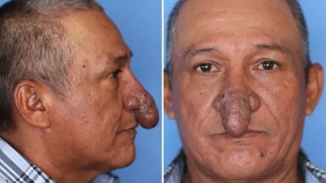 美国男子患怪病长“阴茎鼻” 六年后动手术重拾信心