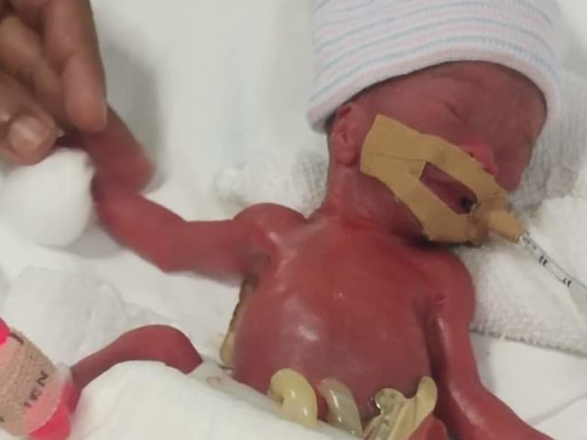 Kwek Yu Xuan weighed only 212 grams when she was delivered at 24 weeks and six days. Kwek Yu Xuan weighed only 212 grams when she was delivered at 24 weeks and six days.