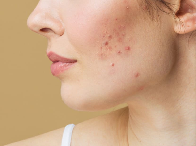 The truth about acne anxiety: What causes it and how do you deal with it?