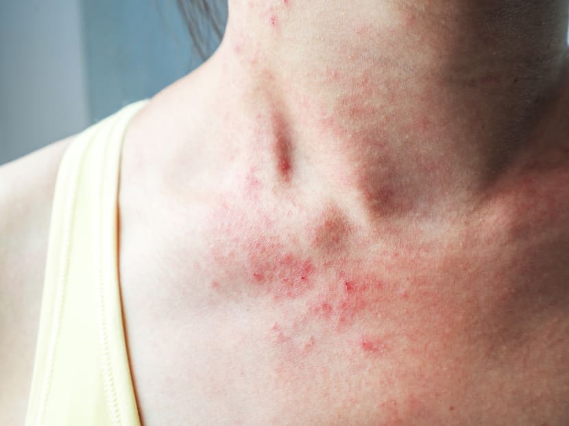 Living with severe eczema: Lost sleep, blood on clothes, mental health struggles