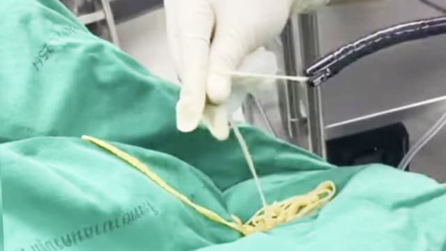 泰国医生从患者口中 拉出数米长寄生虫   
