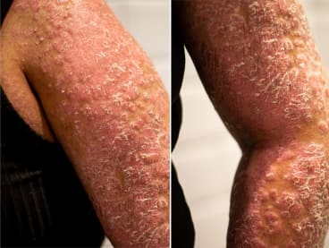 Close-up views of the arm of Ms Emmylou Casanova, who suffers from generalised pustular psoriasis. This was after a flare-up of the disease, which is not contagious.