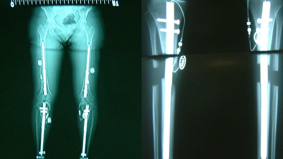 Bones cut and pulled apart in the quest to be taller TODAY