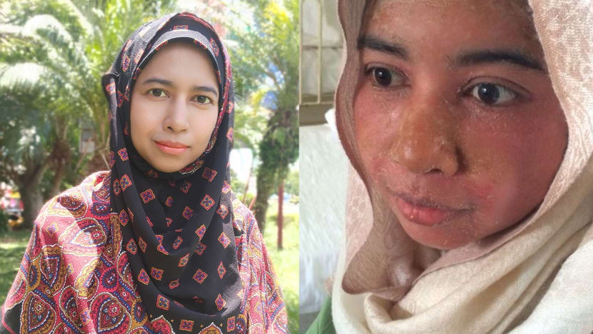Perihnya penyakit kulit langka tak surutkan semangat wanita ini raih magister dan besarkan empat anak