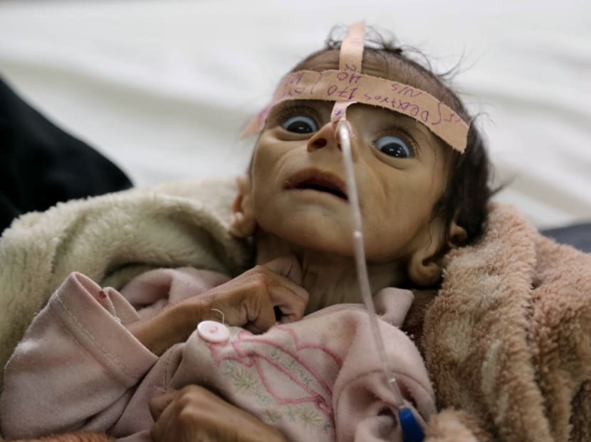 An infant’s 5-month life points to hunger’s spread in Yemen