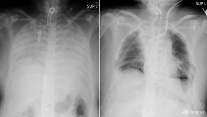 COVID-19 patient in Japan receives lung transplant from living donors COVID-19 patient in Japan receives lung transplant from living donors