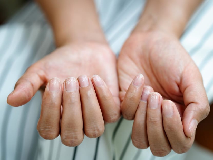 Bruised or ingrown toenail, broken fingernail – when should you see a doctor and when can you just let it grow? Bruised or ingrown toenail, broken fingernail – when should you see a doctor and when can you just let it grow?