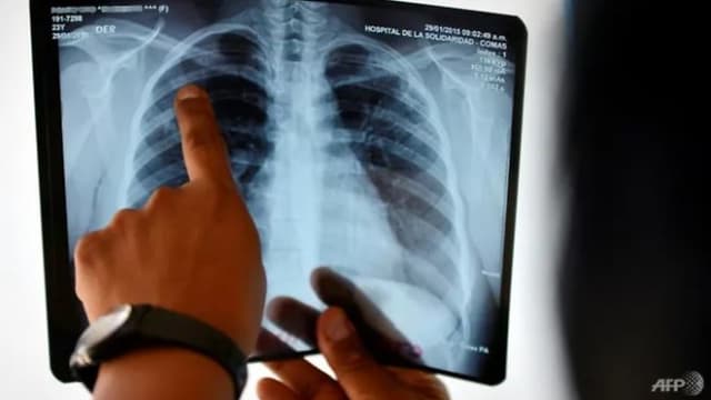 全球肺结核新病例20多年来首次上升
