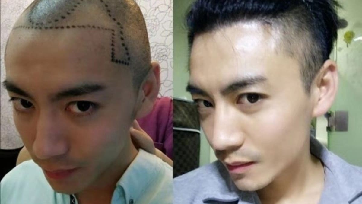 Millennial Chinese men going bald younger, getting hair transplants to  restore their locks and confidence - TODAY