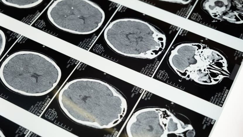Masalah otak didapati pada 1% pesakit COVID-19 di hospital