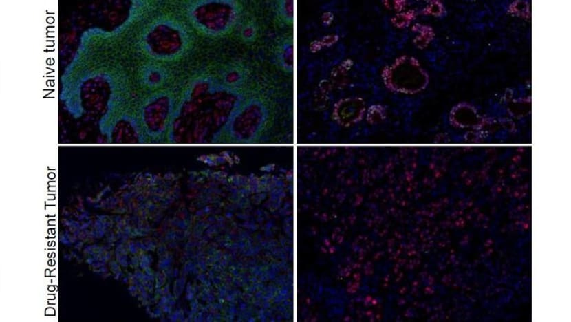 Singapore scientists identify new method of tackling treatment-resistant cancer Singapore scientists identify new method of tackling treatment-resistant cancer