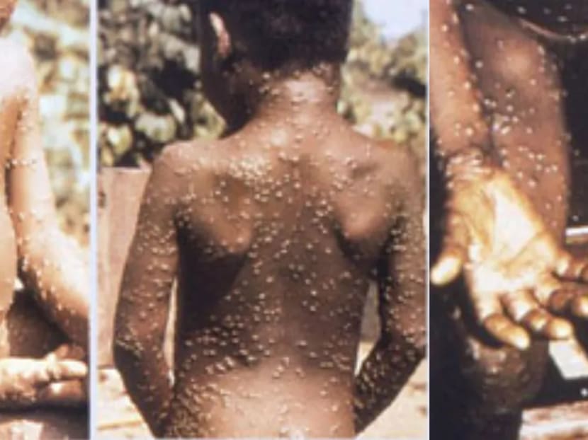 Why wiping out smallpox has stoked risk of monkeypox Why wiping out smallpox has stoked risk of monkeypox