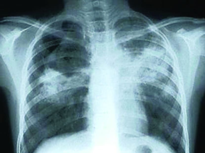 Tuberculosis x-ray. TODAY file photo
