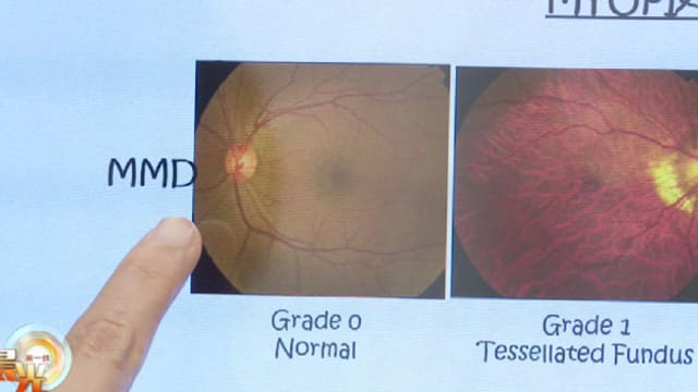 晨光|善方保健：高度近视增患青光眼风险 矫正视力手术增检验难度