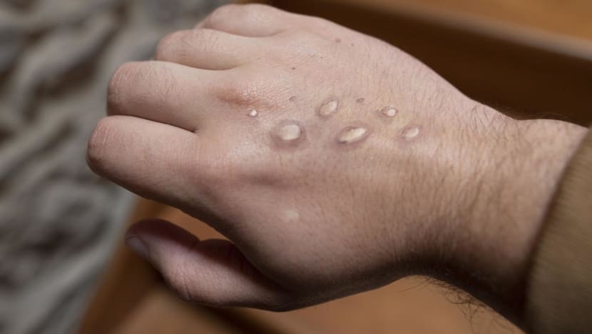 Singapore confirms imported case of monkeypox after flight attendant develops fever and rashes Singapore confirms imported case of monkeypox after flight attendant develops fever and rashes